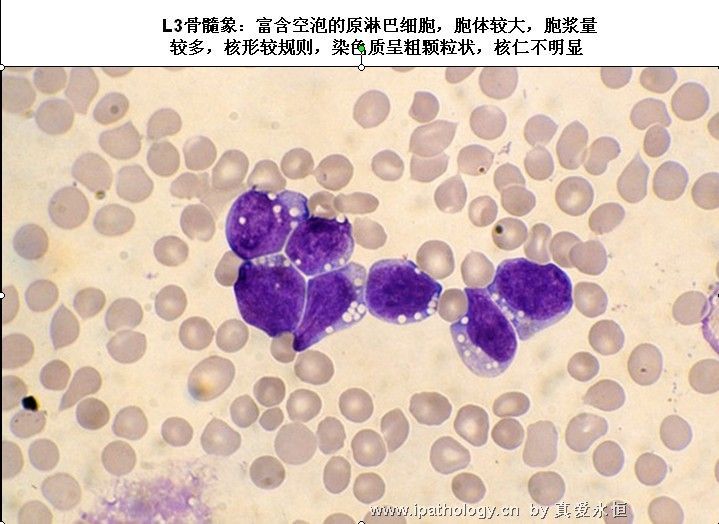 急性淋巴细胞白血病图34