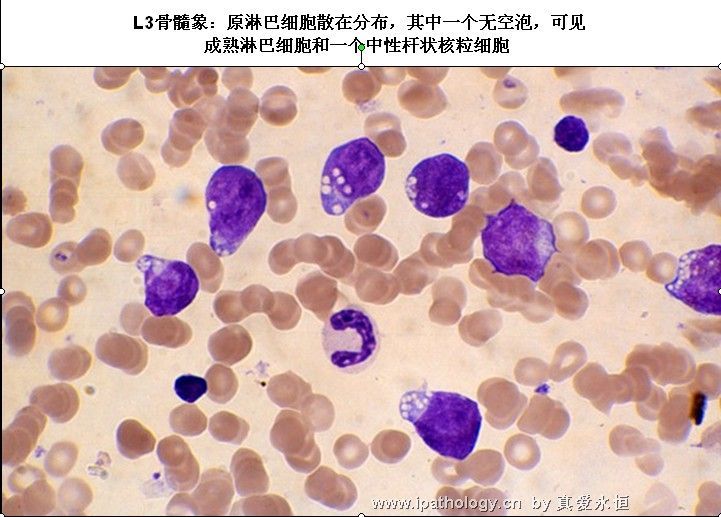 急性淋巴细胞白血病图35