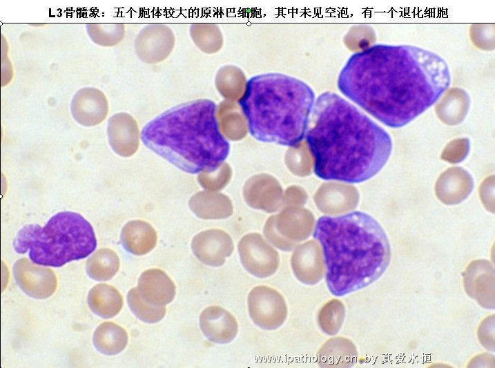 急性淋巴细胞白血病图36