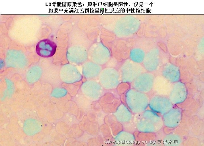 急性淋巴细胞白血病图37