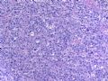 Vulvar anaplastic large T cell lymphoma ALK-1 negative (cqz1)图3