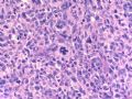 Vulvar anaplastic large T cell lymphoma ALK-1 negative (cqz1)图4