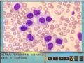 毛细胞白血病图2