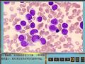 毛细胞白血病图3
