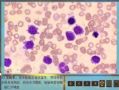 毛细胞白血病图4