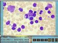 毛细胞白血病图5