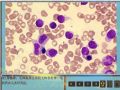 毛细胞白血病图6