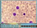 毛细胞白血病图8