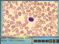 毛细胞白血病图9