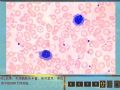毛细胞白血病图10