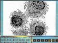 毛细胞白血病图14