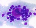 Breast FNA. 69-year-old female, breast lump图2