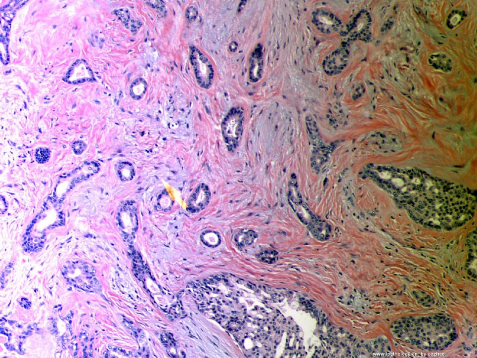 Breast tubular leisons, MGA and differential diagnosis (cqz 2)图1