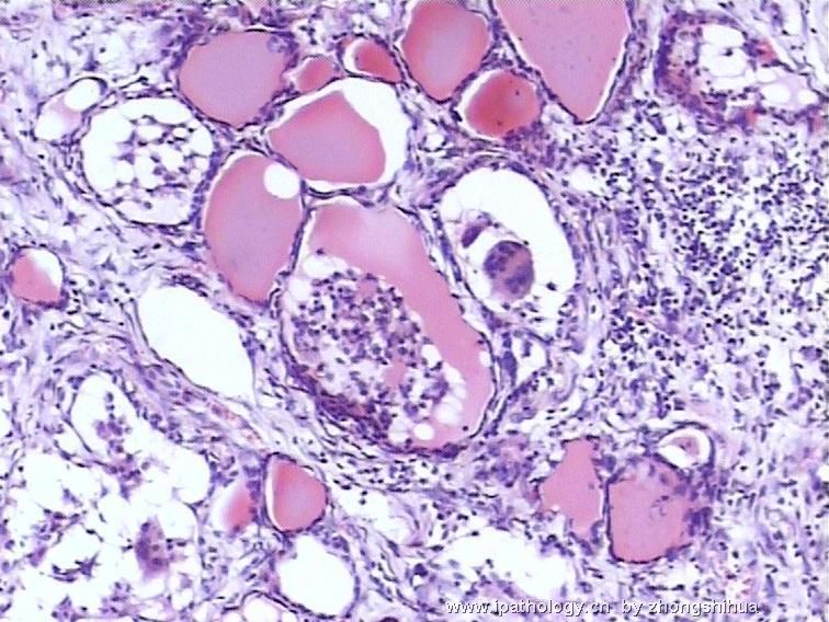 甲状腺典型病变图5
