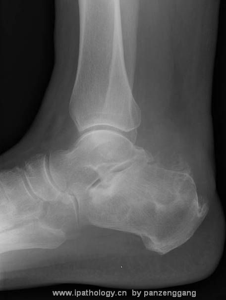 right ankle bone tumor图1