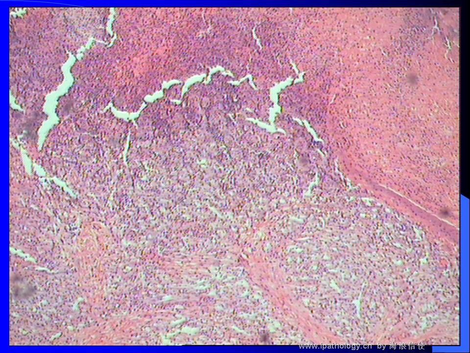 山东读片2001-2 M42Y上唇粘膜肿物图1