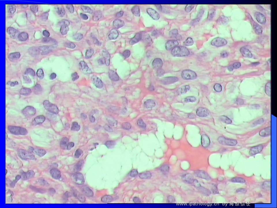 山东读片2001-2 M42Y上唇粘膜肿物图3