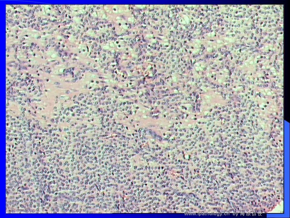 山东读片2001-6 M50Y左胸壁肿物图2