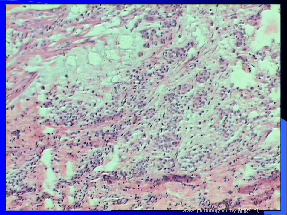 山东读片2001-6 M50Y左胸壁肿物图5
