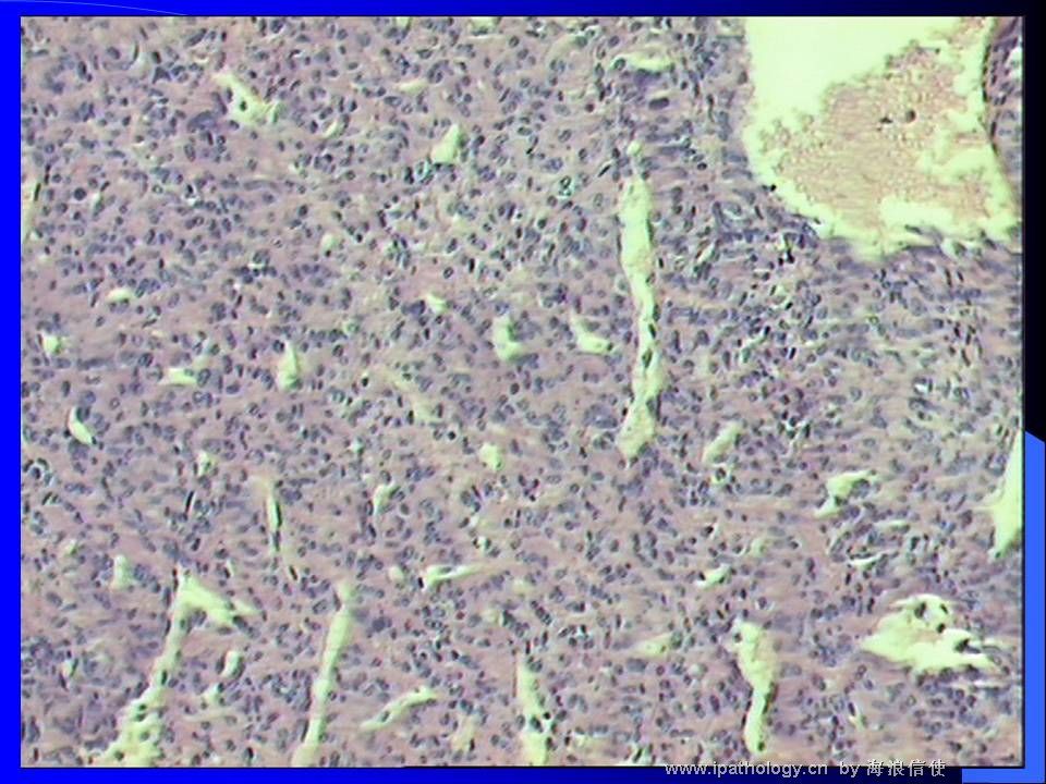 山东读片2001-9 M44Y左肺上叶肿瘤图2