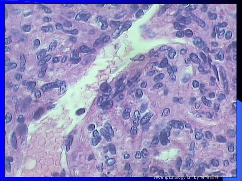 山东读片2001-9 M44Y左肺上叶肿瘤图3