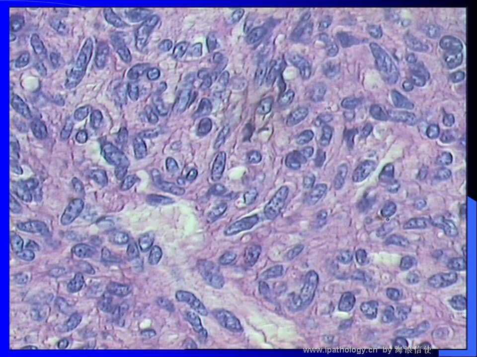 山东读片2001-9 M44Y左肺上叶肿瘤图4