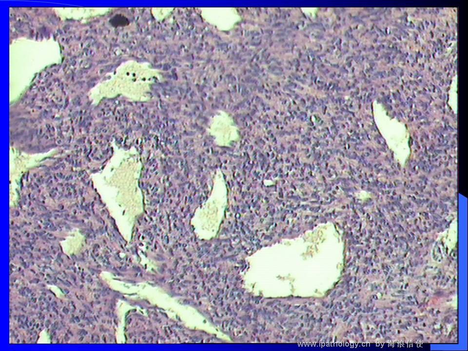 山东读片2001-9 M44Y左肺上叶肿瘤图5