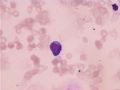 两例怀疑“淋巴瘤”的骨髓细胞形态图1