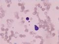 两例怀疑“淋巴瘤”的骨髓细胞形态图4