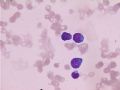 两例怀疑“淋巴瘤”的骨髓细胞形态图8