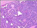 Breast encapsulated (intracystic) papillary carcinoma (cqz 3)图2