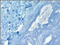 Breast encapsulated (intracystic) papillary carcinoma (cqz 3)图4
