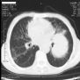 [081112]肺穿刺活检图1