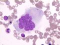 MA巨幼细胞性贫血图1