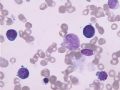 MA巨幼细胞性贫血图2