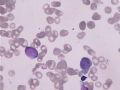 MA巨幼细胞性贫血图3