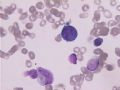 MA巨幼细胞性贫血图4