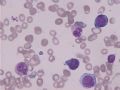 MA巨幼细胞性贫血图6