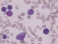 MA巨幼细胞性贫血图8