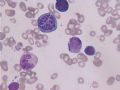 MA巨幼细胞性贫血图9