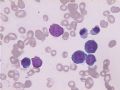 MA巨幼细胞性贫血图10