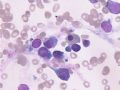 MA巨幼细胞性贫血图11