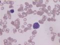 MA巨幼细胞性贫血图12