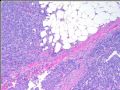 Breast encapsulated papillary carcinoma with focal frankly invasion (cqz 4)图3