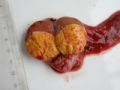 睾丸肿块-冷冻切片图1