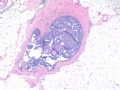 Breast atypical papilloma (cqz 5)图1