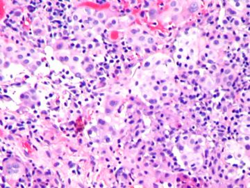 Older women pelvic mesothelioma (cqz2)图2