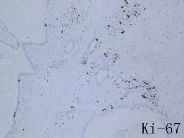 免疫组化结果分析5－－前列腺2图11