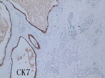 免疫组化结果分析5－－前列腺2图12