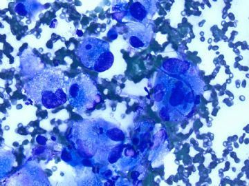 Lung mass FNA today Please join in the discussion图3